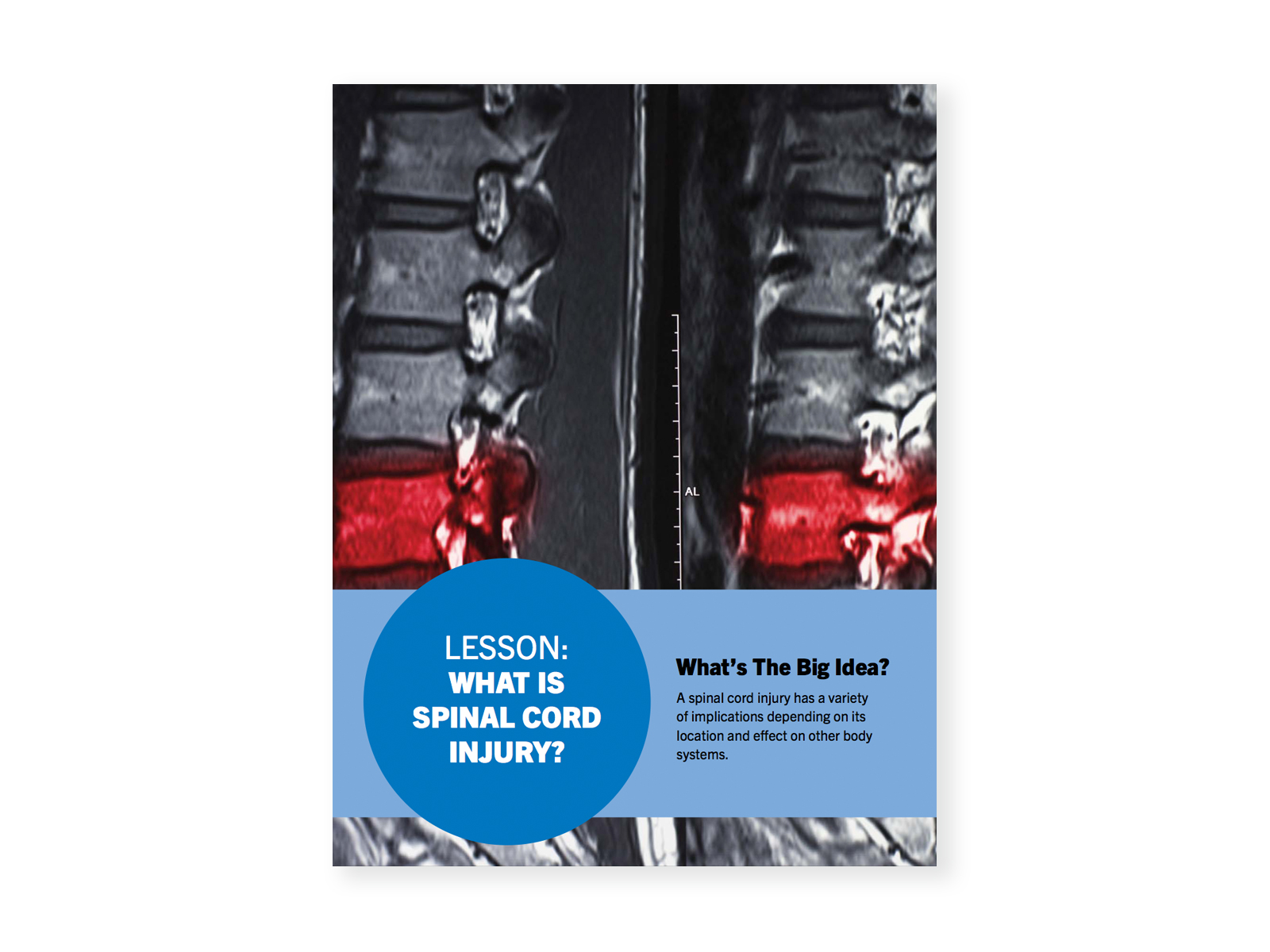 Image of an x-rayed portion of a spine - one vertebra is highlighted in red. Cover for "What is Spinal Cord Injury" lesson.